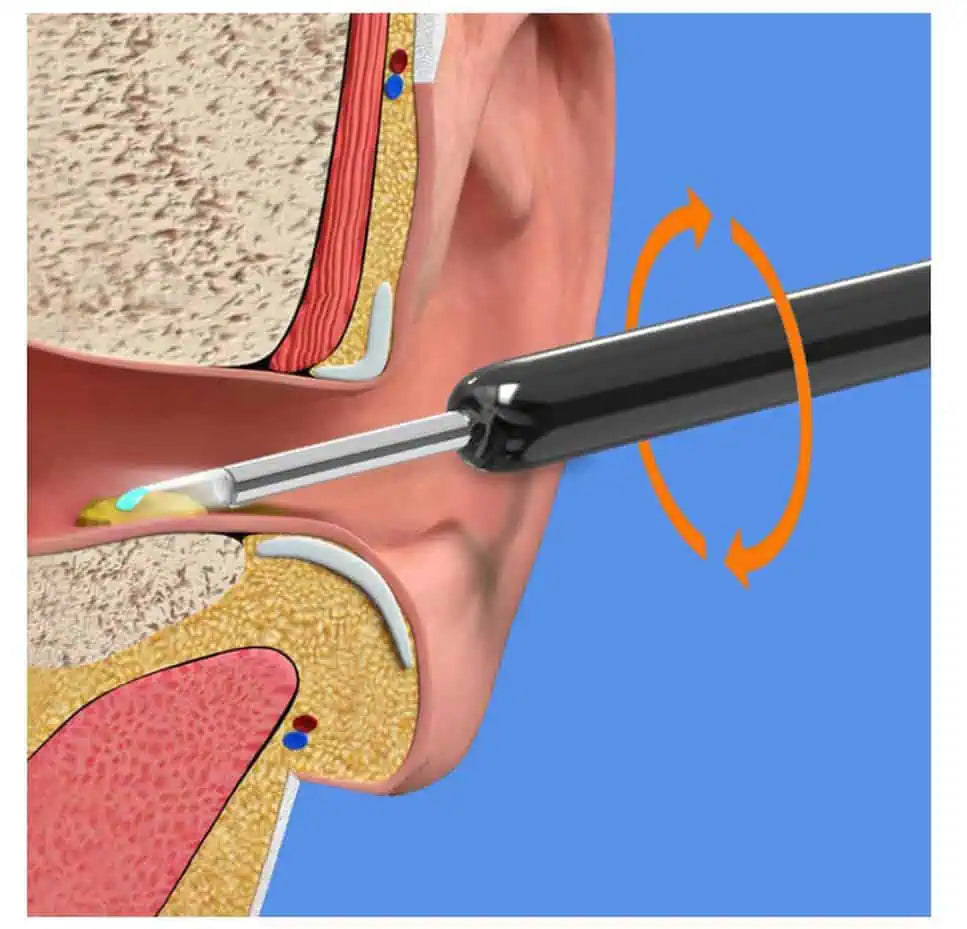 Earwax Removal Kit